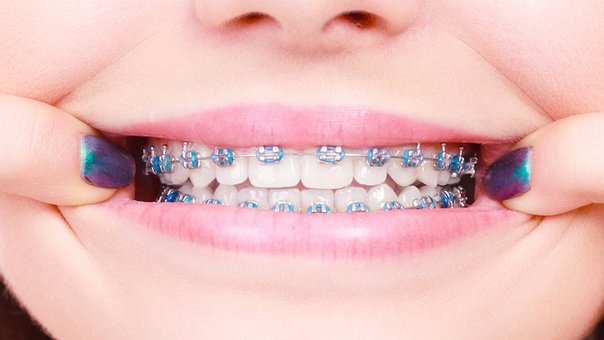 sexo y brakets