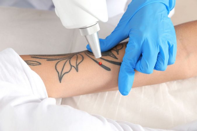 Consejos del uso del laser para eliminar un tatuaje Merca2.es