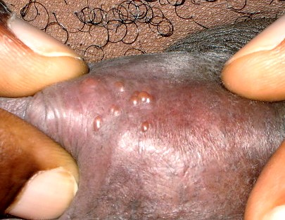 herpes genital