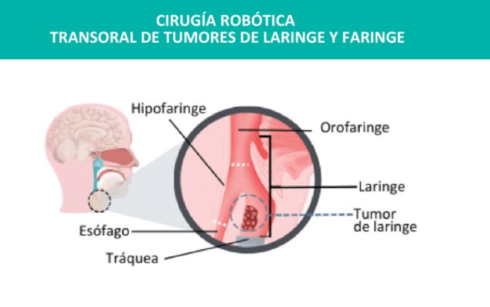 Cirugia robótica transoral para tumoresumor de faringe y Laringe