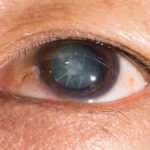 Descubre la vitamina que te protegerá contra el glaucoma y las cataratas