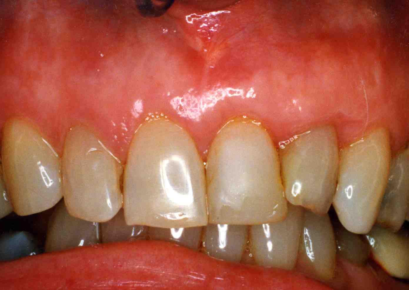 ROL DE LA NUTRICIÓN EN LA PREVENCIÓN DE LA INFLAMACIÓN GINGIVAL