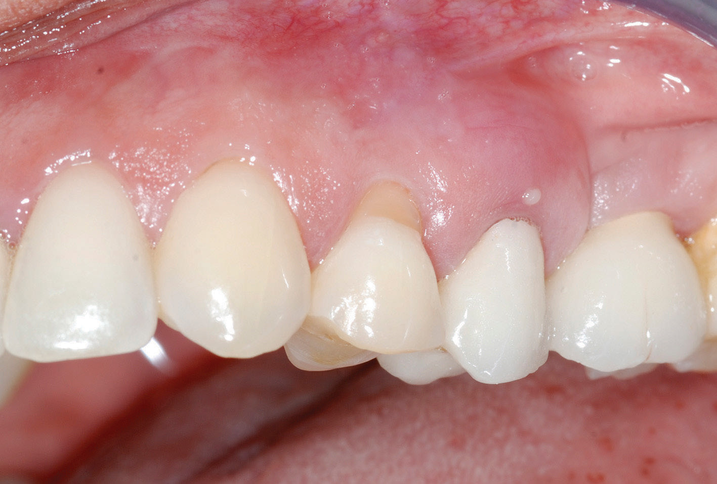 CAUSAS DE LA INFLAMACIÓN GINGIVAL