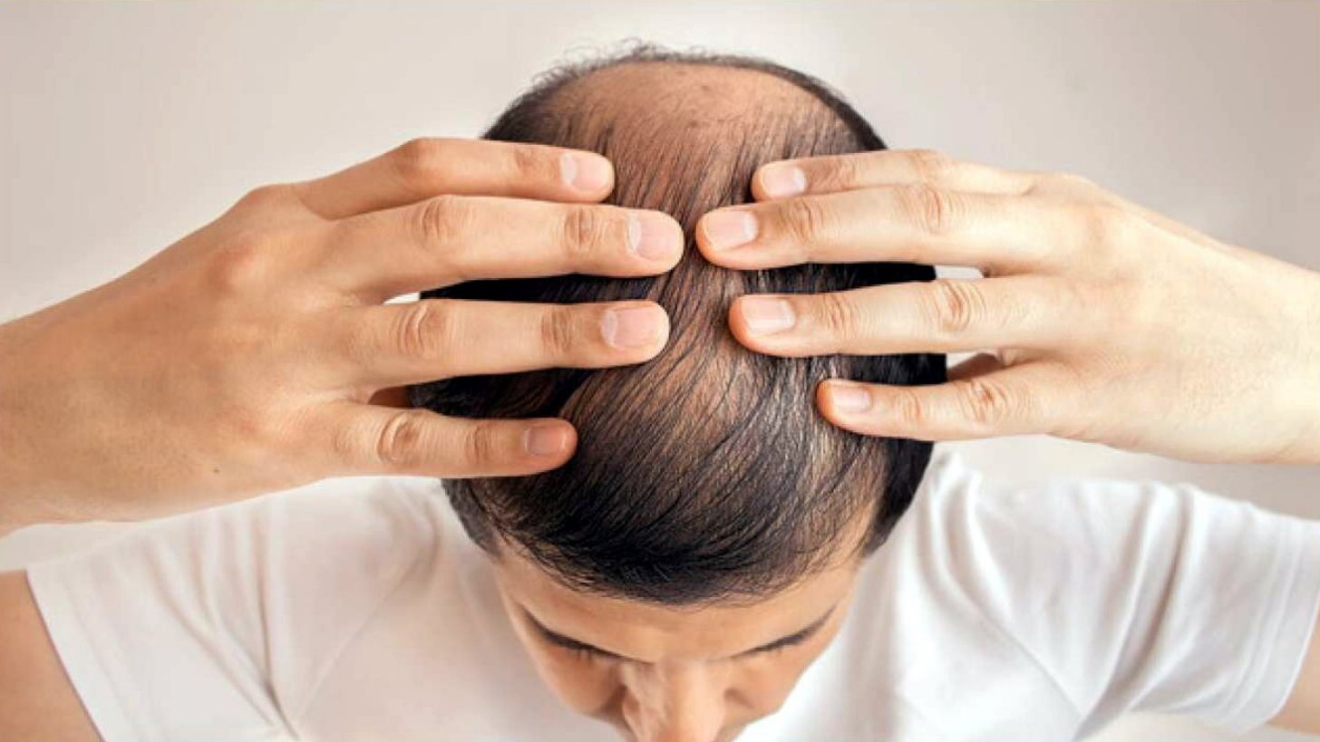 NUTRICIÓN Y ALOPECIA: ALIMENTANDO EL FOLLÍCULO DESDE DENTRO