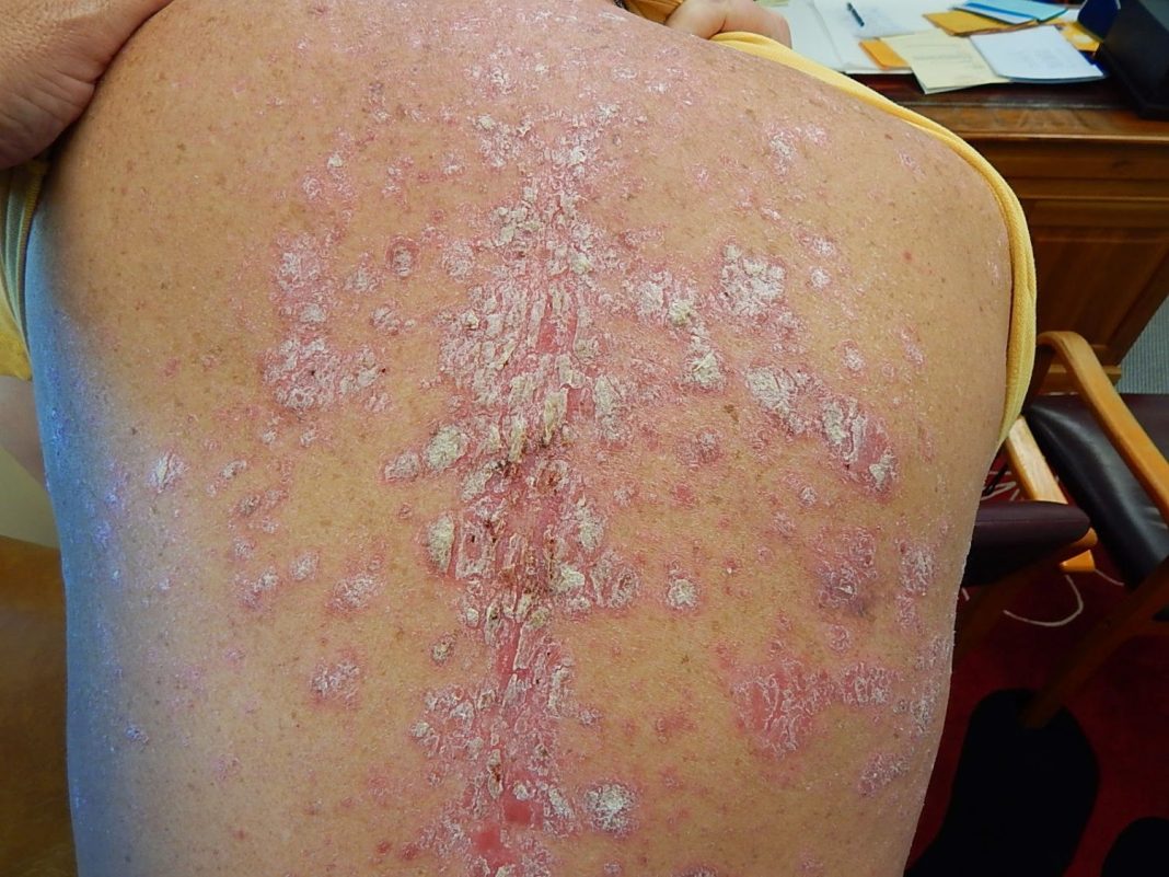 Cómo saber si tienes psoriasis y cómo tratarla