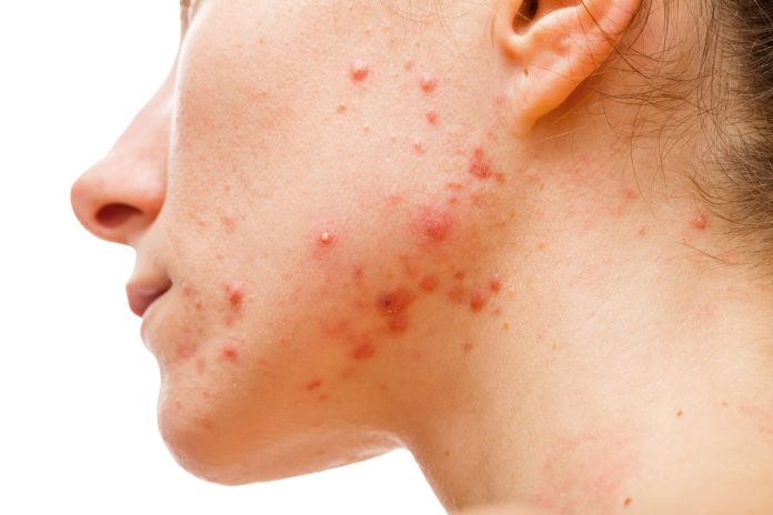 El mejor tratamiento que promete eliminar el acné