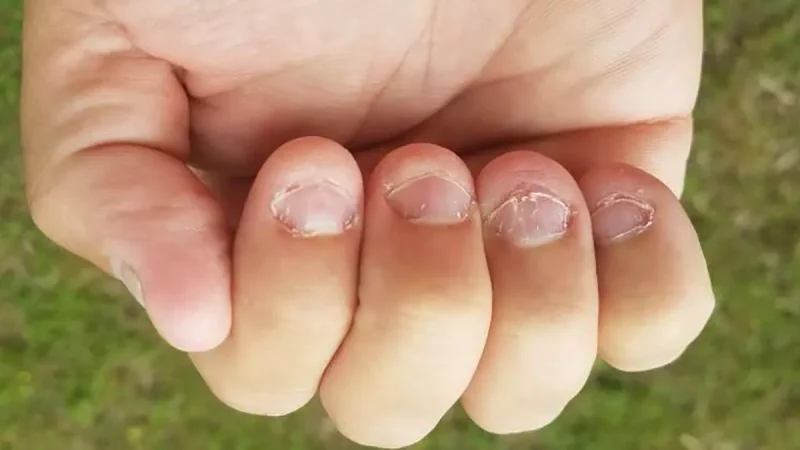 ¿Qué consecuencias puede tener morderse las uñas?