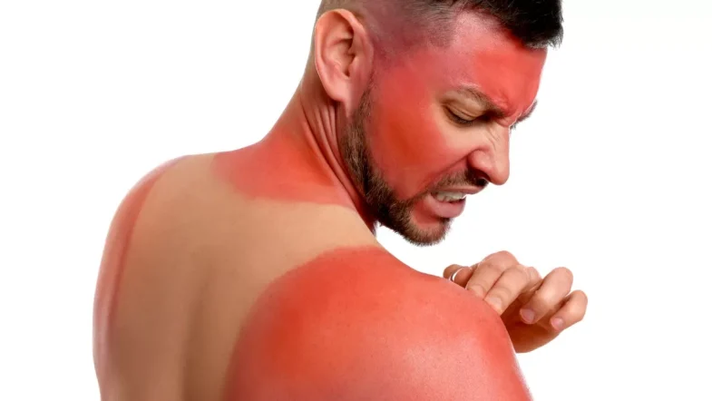 Recupera tu piel de las quemaduras solares con este remedio casero