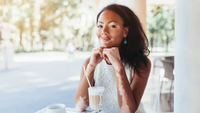 Té milenario que reduce el vitíligo de forma progresiva