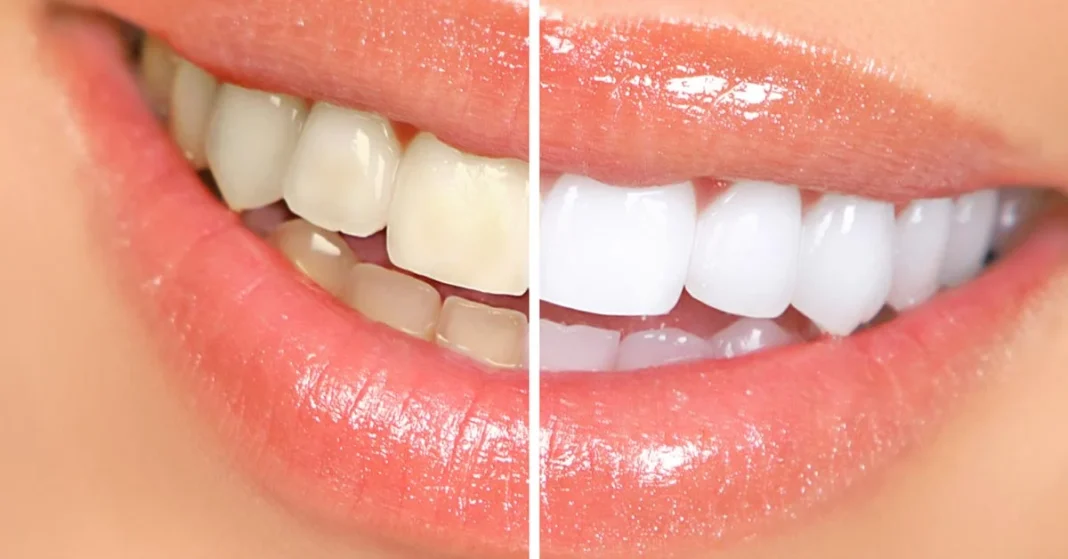 ¿Tienes los dientes amarillos? Estos son los mejores trucos naturales para su blanqueamiento