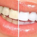 ¿Tienes los dientes amarillos? Estos son los mejores trucos naturales para su blanqueamiento