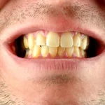 ¿Tienes los dientes amarillos? Estos son los mejores trucos naturales para su blanqueamiento